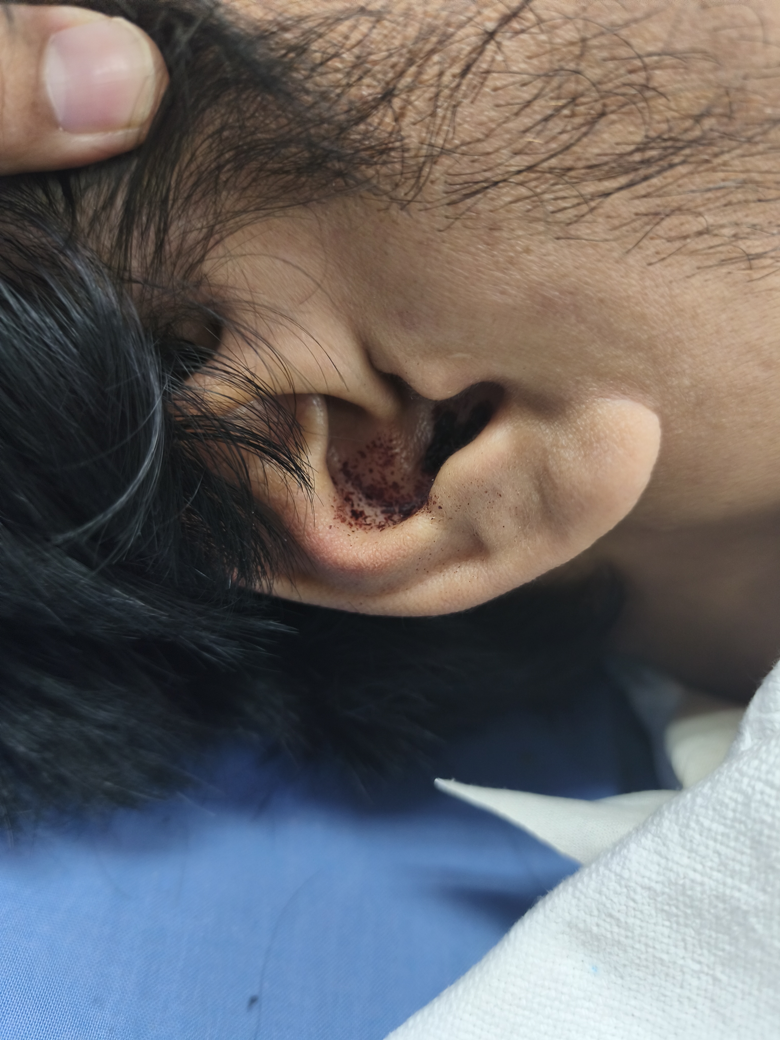 Some ear bleed, turned out to be nothing